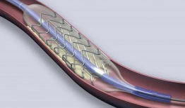 心脏支架手术视频,技术革新与患者康复之路